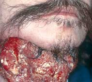 Un tumor en el cuello producido por el consumo de tabaco.
